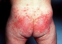 rash5.jpg